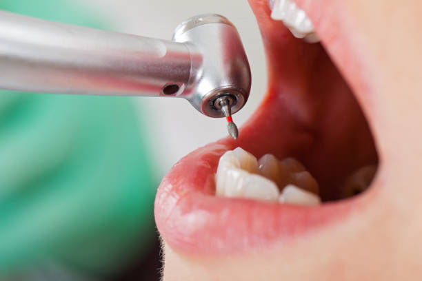 Best Emergency Wisdom Tooth Extraction in Pleasant Grove, AL